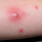 boil ca-mrsa and about mrsa statistics