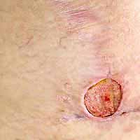 Staph skin infection on arm