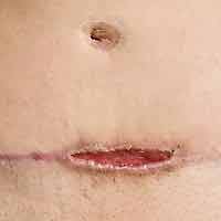 Staph skin infection on arm