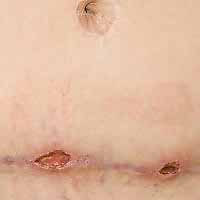 baby with staph infection lesions