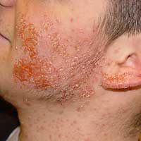 Staph infections and eczema: What’s the connection ...
