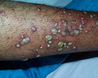 staph infection photo on arm