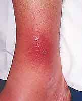 cellulitis on the leg