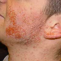 contact dermatitis