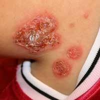 staph infection as impetigo