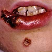 impetigo staph picture