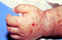 baby with staph infection lesions