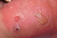 MRSA infection - Mayo Clinic