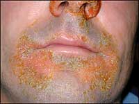 picture of Staph impetigo on the face