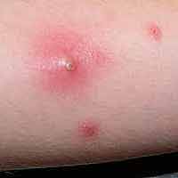 Small Itchy Clear Bumps - Skin Forum - eHealthForum