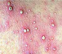 staph infection as folliculitis
