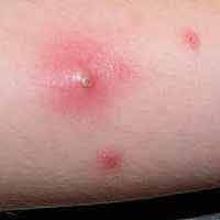 Boil skin infection from Staph
