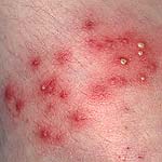 folliculitis-image.jpg