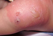 Staph cellulitis infection