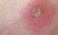 Malassezia (Pityrosporum) Folliculitis