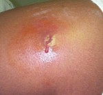 MRSA skin infection